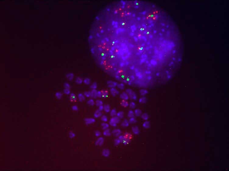 Identificados los mecanismos que provocan la resistencia al tratamiento de cáncer de pulmón con Sotorasib, el primer inhibidor de KRAS